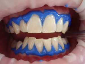 Beljenje zob predstavlja alternativo za zobne luske